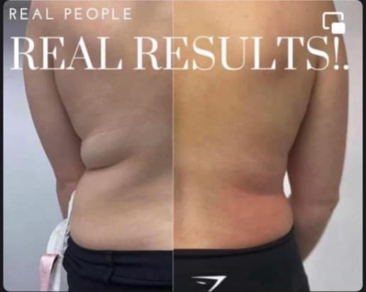 Before and after fat freezing and cavitation treatment at HBT Aesthetics