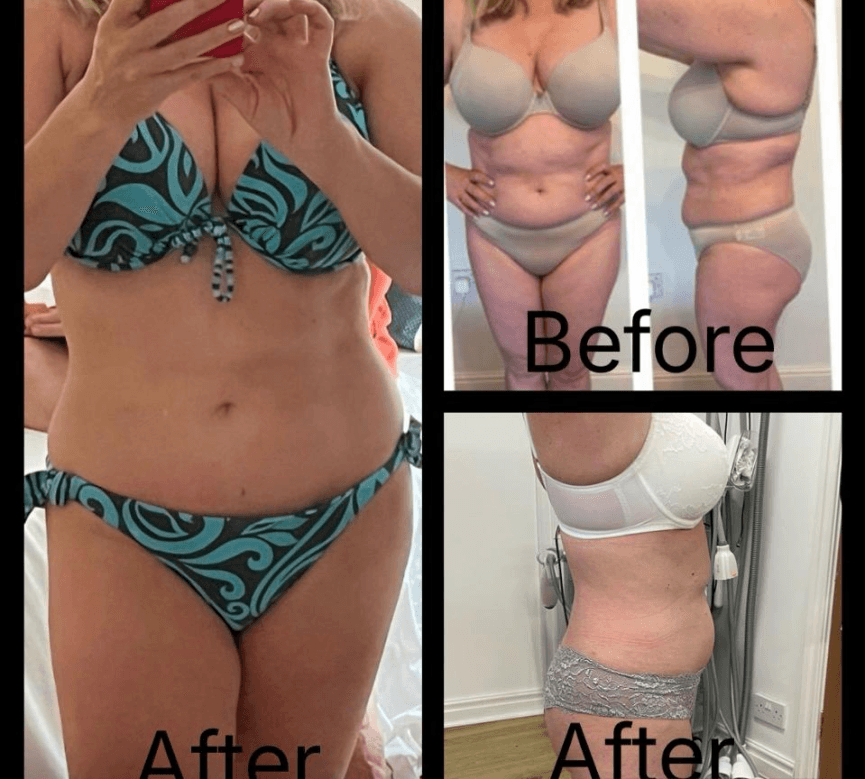 Full body contouring before and after